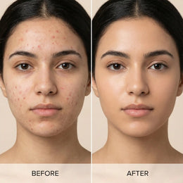 تخلصي من حب الشباب والرؤوس السوداء نهائيًا | مجموعة طبيعية رباعية من سيوة